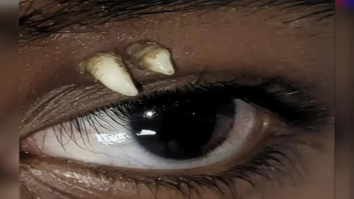 Imagem de Adolescente descobre dente crescendo acima do olho e surpreende médicos na Índia
